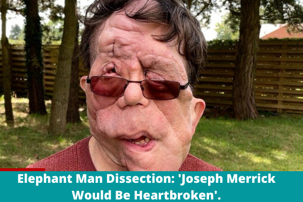 Elephant Man Dissection: 'Joseph Merrick Would Be Heartbroken'.